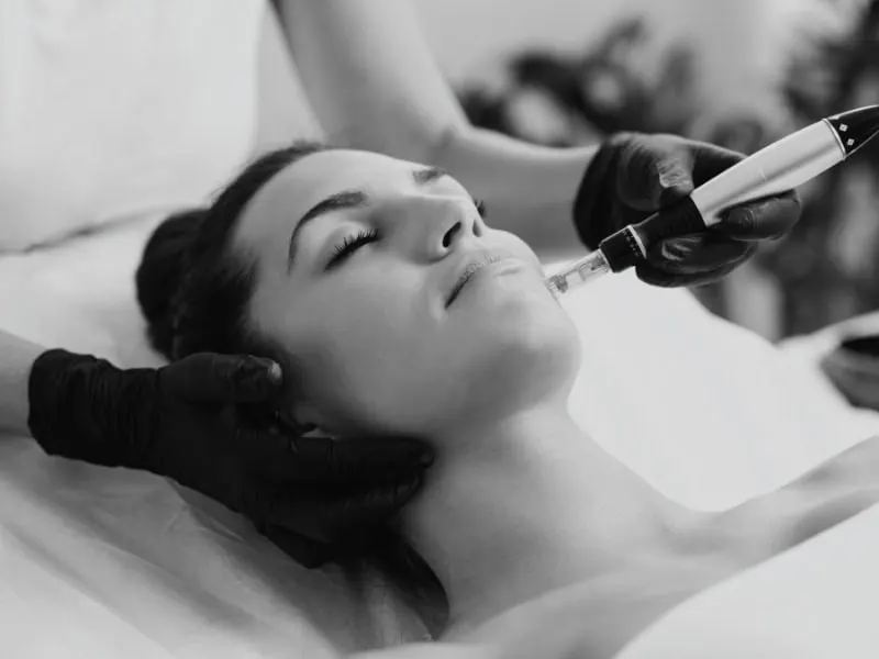 Tratamiento Biopen de microneedling facial en Centro EBM